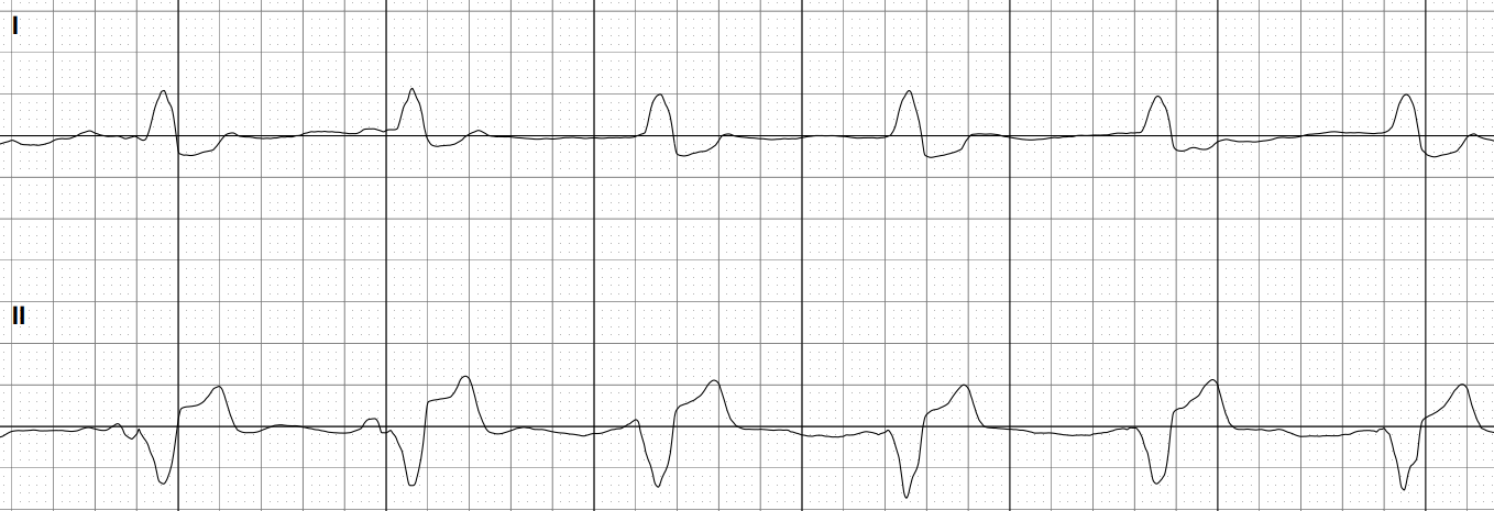 12_9_24_AI interpretation of an ECG after pacemaker implantation.png